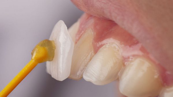 Lente de contato dental realmente desgasta os dentes? Entenda