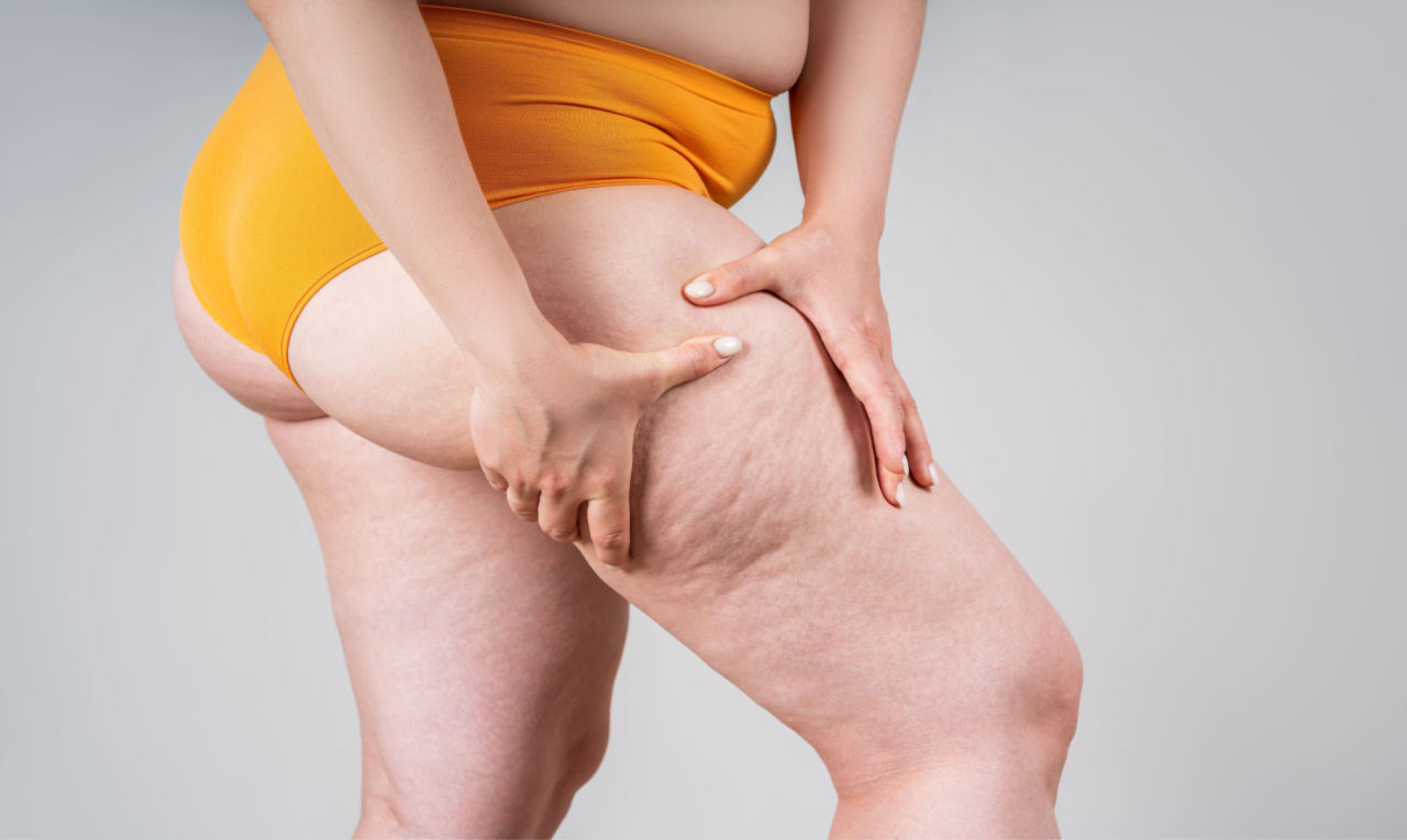 Cintura fina e pernas grossas? Nem sempre é obesidade, pode ser lipedema –  Blog da Denise Drenagem Linfatica BH