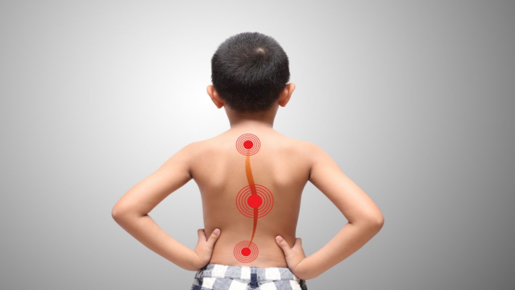 Escoliose em crianças e adolescentes: como identificar os primeiros sinais