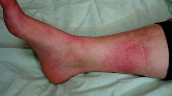 Primeiros sintomas da erisipela não surgem na pele; entenda