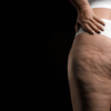 lipedema