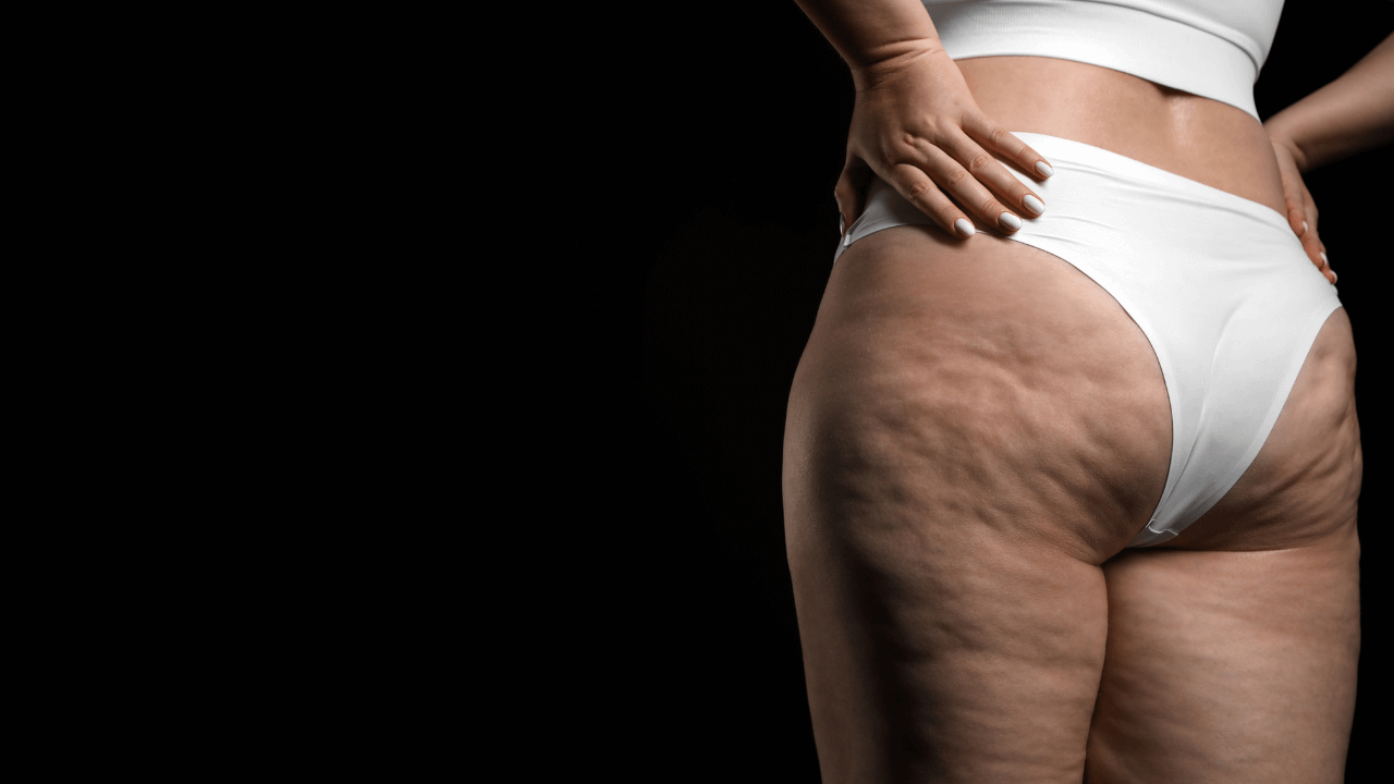 lipedema